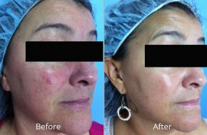 HydraFacial MD  What is it?