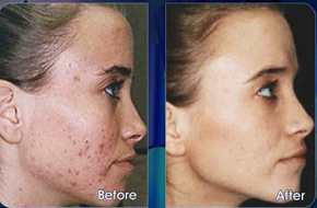 SO GENTLE SKIN PEEL  -  NO SUN SENSITIVITY